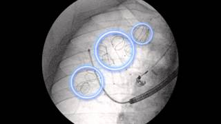 New Procedure Helps Patients with Severe Emphysema [upl. by Starbuck]