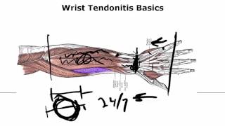 Wrist Tendonitis Basics  Critical To Know If You Want A Fix [upl. by Odlanier13]