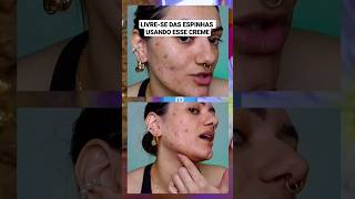 Acabou com a ACNE l ÁCIDO GLICÓLICO da Creamy com Niacinamida e AlfaBisabolol acne skincare [upl. by Ahtanaram]