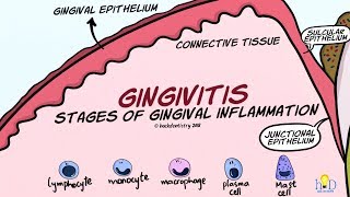 Gingivitis Stages of Gingival Inflammation [upl. by Aneri]