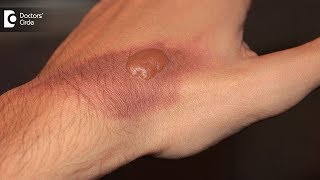 How to treat a burn blister at home Tips to avoid burn scar  Dr Pavan Murdeshwar [upl. by Ear]