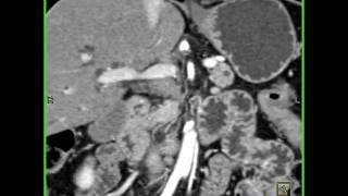 Abdomen Pancreas Staging of pancreatic cancerAnalysis of arterial and venous structures10 of 11 [upl. by Blondy]