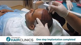 FUE Hair Transplantation StepbyStep by Dr Anastasios Vekris [upl. by Urbas114]