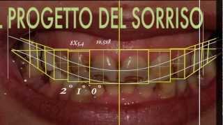 Cambiare laspetto del sorriso con faccette dentali  SMILE DESIGN [upl. by Aidyl]