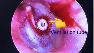 Ventilation tube insertion Part2 [upl. by Antin]