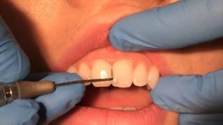 Periodontal Probing [upl. by Eednam494]