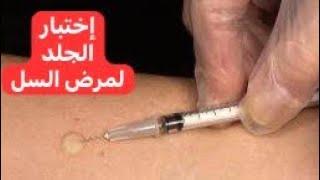 إختبار الجلد لمرض السل Tuberculin Skin Test [upl. by Jenifer228]