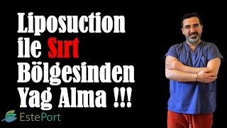 Liposuction ile Sırt Bölgesinden Yağ Alma [upl. by Anaig904]