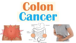 Colon Cancer CRC Risk Factors Pathogenesis Symptoms Diagnosis Staging Treatment [upl. by Erhart]