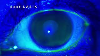 post LASIK eye [upl. by Ziguard]