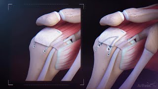 CuffMend™ Rotator Cuff Repair Augmentation System [upl. by Gustavo]