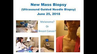 New Mass Biopsy [upl. by Misti450]