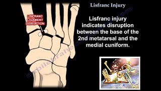 Lisfranc Injury  Everything You Need To Know  Dr Nabil Ebraheim [upl. by Stroud]