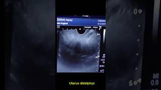 Uterus didelphys with right adnexal haemorrhage cyst [upl. by Ellehcal]