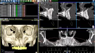 Software 3Diagnosys  Dalla diagnosi alla pianificazione implantare  Caso 1 [upl. by Waiter]