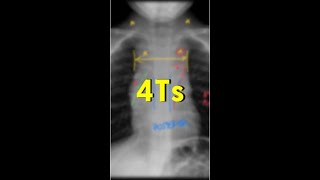 4Ts do mediastino anterior [upl. by Sneed]