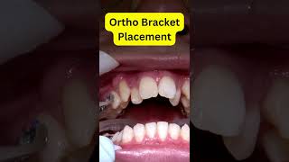 Braces Installation REVEALED Step by Step [upl. by Reklaw821]