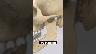 TMJ Disorders 3D Animation [upl. by Htnnek]