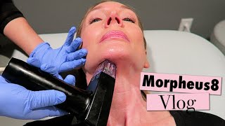 Morpheus8 Neck Treatment amp Recovery Vlog [upl. by Ihana]