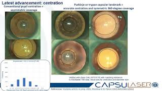 Capsulaser Cerrahi Protokol [upl. by Tollman]