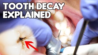 Tooth Decay Cavity Explained  Cavities vs Fillings vs Dental Caries [upl. by Lindsy673]