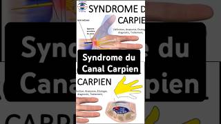 Syndrome du Canal Carpien canalcarpien paresthesie nerf Median medianetchannel neurologie comp [upl. by Ecnarual]