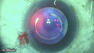 Phaco using capsulaser [upl. by Idmann]