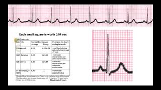 How to Determine Intervals amp Segments on EKG EXPLAINED [upl. by Otrebire]