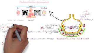 ARDS acute respiratory distress syndromeشرح [upl. by Yzus446]