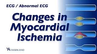 ECG 29  Changes in Myocardial Ischemia [upl. by Yrrac30]