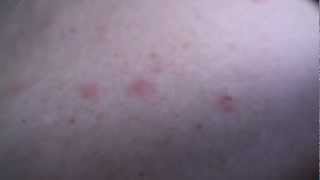 Shingles Rash Early Stages [upl. by Maurer133]