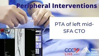 PTA of left mid SFA CTO  Peripheral Interventions August 28 2013 [upl. by Akeret]