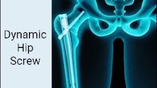 Dynamic Hip Screw Surgical Technique and Rehabilitation Tips [upl. by Mchail]