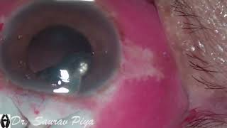 COMBINED CATARACT IMMATURE SENILE CATARACT AND GLAUCOMA SURGERY  Dr Saurav Piya [upl. by Niabi]