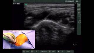 Ultrasoundguided supraclavicular subclavian vein catheterization In Children 1 [upl. by Jain]