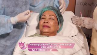 Nonsurgical facelift using combination Ultra Vlift Threads [upl. by Rosenberger]