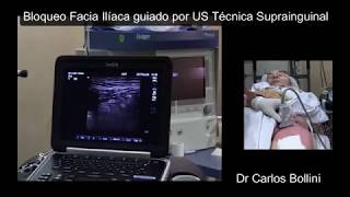 Bloqueo Fascia Iliaca Suprainguinal guiado por Ultrasonografía [upl. by Aynav]