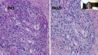 Tip48Gastric Adenocarcinoma with Enteroblastic Differentiation [upl. by Lhamaj]