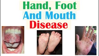 Hand Foot and Mouth Disease  Viruses Pathophysiology Signs and Symptoms Diagnosis Treatment [upl. by Ozan66]