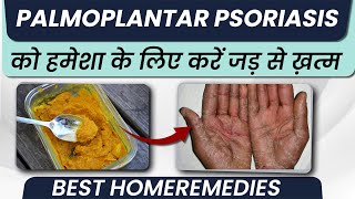 पामोप्लांटर सोरायसिस का घरेलू इलाज  Palmoplantar Psoriasis Symptoms and Treatment in Hindi [upl. by Yenohtna]