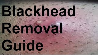 Blackhead Removal Guide [upl. by Race]