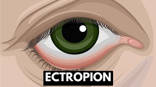 Ectropion Causes Symptoms Complications And Treatment [upl. by Elwaine]