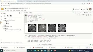 Deeplearning in Health care  Image Classification usingVGG16 [upl. by Giannini]