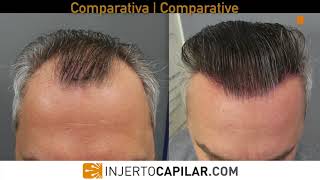 3601 FUE Grafts NW III vertex White hair turns dark Injertocapilarcom 19282017 [upl. by Ihp939]