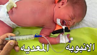 تركيب انبوبه المعده للاطفال حديثى الولاده  The How to Make an Orogastric Tube for Kids Case [upl. by Bakki]