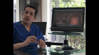 Mamoplastia de reducción  Dr Ivan Santos  Cirugía plástica en Colombia [upl. by Grory]