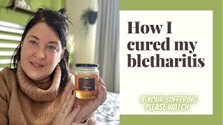 How I cured my BLEPHARITIS  chronic eye condition [upl. by Yduj611]