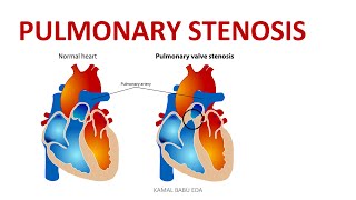 PULMONARY STENOSIS [upl. by Hanselka]