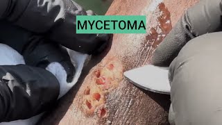 Mycetomafungal infection of foot DrArifMDDermatologist footinfection [upl. by Nessaj730]