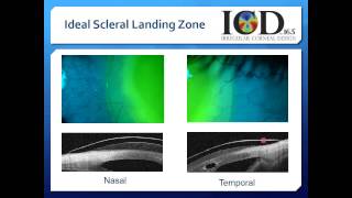 Scleral Contact Lenses Video 5 [upl. by Koball]